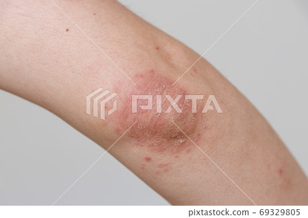 Elbow dermatitis 69329805