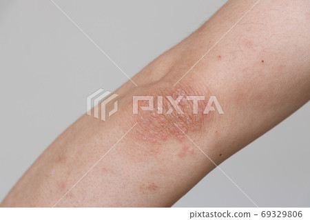 肘部皮炎 69329806