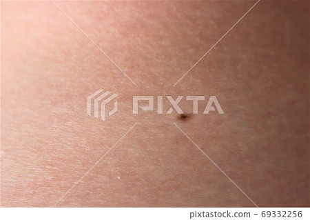 Mole on female skin Mole on female skin 69332256