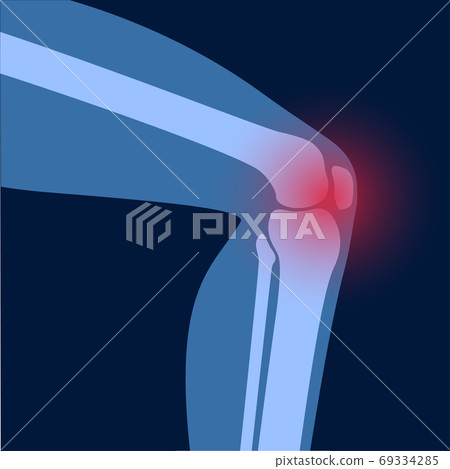 Arthritis in knee joint Arthritis in knee joint 69334285