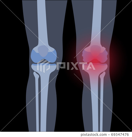 Arthritis in knee joint 69347476