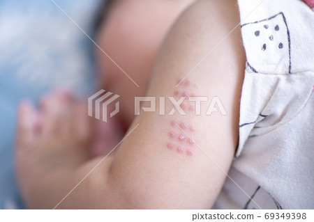 一個7個月大男孩的BCG痕跡 69349398
