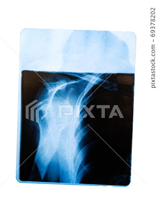 X-ray of shoulder isolated on white background 69378202