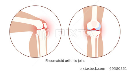 Arthritis in knee joint 69380861