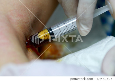 Hands of woman nurse with gloves using syringe,cleaning the wound on the armpit,clean up by normal saline solution and tincture,betadine to disinfecting in the skin to reduce risk of wound infection Hands of woman nurse with gloves using syringe,cleaning the wound on the armpit,clean up by normal saline solution and tincture,betadine to disinfecting in the skin to reduce risk of wound infection 69389597