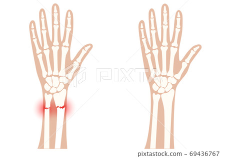 Fracture x ray concept 69436767