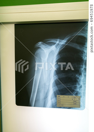 radiograph, x-ray photo, roentgen 69451978