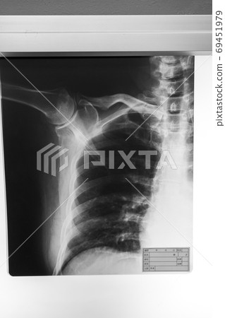 x光透射片 射線掃描 骨頭 69451979
