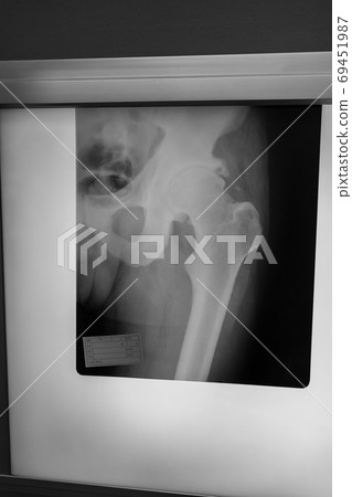 radiograph, x-ray photo, x-ray scan 69451987