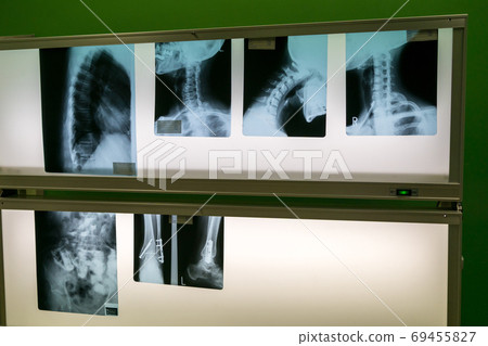 radiograph, x-ray photo, x-ray scan 69455827