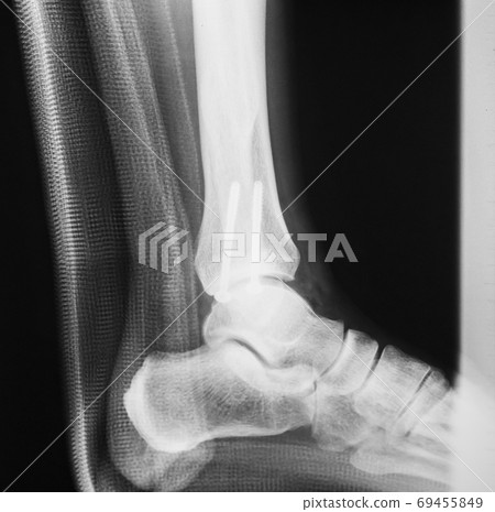 roentgen, x-ray scan, bone 69455849