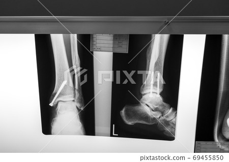 射線掃描 骨頭 骨骼 69455850