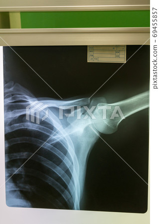 roentgen, x-ray scan, bone 69455857