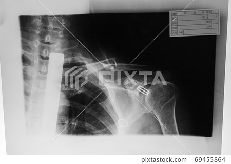 roentgen, x-ray scan, bone 69455864