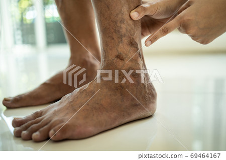 Hands of female doctor is showing varicose vein in the leg of asian senior man,vascular disease,spider veins,varicose veins,superficial veins problems,elderly people sore,swollen skin,muscle pain Hands of female doctor is showing varicose vein in the leg of asian senior man,vascular disease,spider veins,varicose veins,superficial veins problems,elderly people sore,swollen skin,muscle pain 69464167