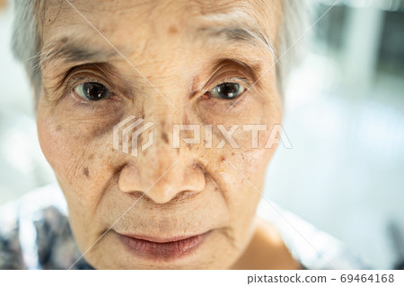 Exhausted asian senior woman suffering from insomnia, chronic insomnia or allergies causing her sunken eye, dark circles, blear eyed,female elderly feeling tired,fatigued, not get a wink of sleep Exhausted asian senior woman suffering from insomnia, chronic insomnia or allergies causing her sunken eye, dark circles, blear eyed,female elderly feeling tired,fatigued, not get a wink of sleep 69464168