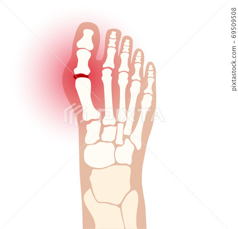 Arthritis foot concept 69509508