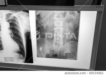 roentgen, x-ray scan, x-ray photo 69534862