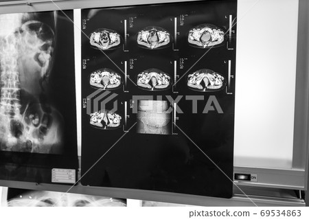 roentgen, x-ray scan, x-ray photo 69534863