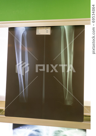 roentgen, x-ray scan, x-ray photo 69534864