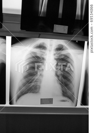 射線掃描 x光透射片 x光 69534866