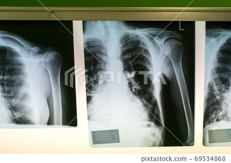 roentgen, x-ray scan, x-ray photo 69534868