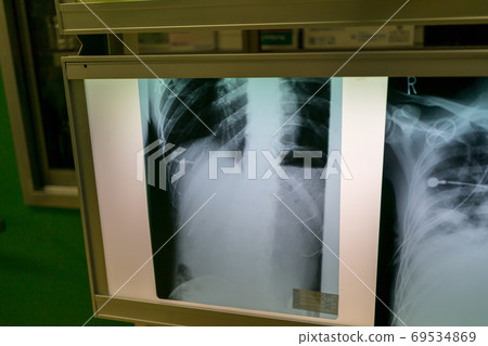 x-ray photo, bone, bones 69534869