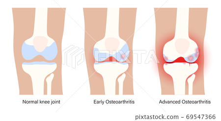 Arthritis in knee joint Arthritis in knee joint 69547366