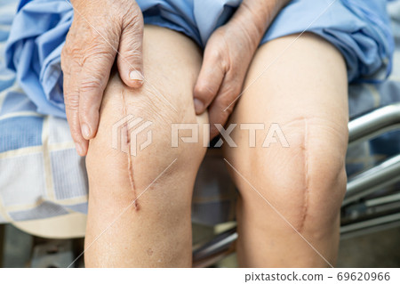 Asian senior woman patient show her scars surgical total knee joint replacement. Asian senior woman patient show her scars surgical total knee joint replacement. 69620966