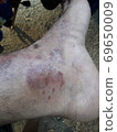 Very  painful  skin  disease  on left  side  of  human' leg . 69650009