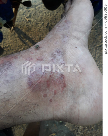 Very painful skin disease on left side of human' leg . Very painful skin disease on left side of human' leg . 69650009