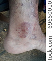 Very  painful  skin  disease  on left  side  of  human' leg . 69650010