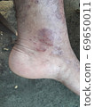 Very  painful  skin  disease  on left  side  of  human' leg . 69650011