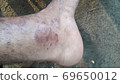 Very  painful  skin  disease  on left  side  of  human' leg . 69650012