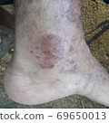 Very  painful  skin  disease  on left  side  of  human' leg . 69650013