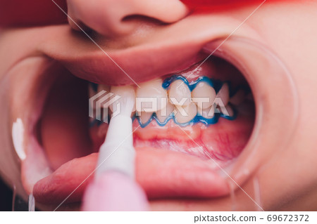 Close-up portrait of a female patient visiting dentist for teeth whitening in clinic,Teeth whitening procedure. Close-up portrait of a female patient visiting dentist for teeth whitening in clinic,Teeth whitening procedure. 69672372