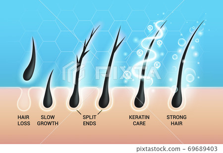Different hair problems and deep salon treatment vector illustrations set, macro view of balding scalp skin and follicles 69689403