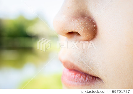 Allergic young woman have eczema dry nose on winter season,female people peeling skin with seborrheic dermatitis,atopic dermatitis symptom on her nose,flaky skin on the face or allergic reaction on fa 69701727