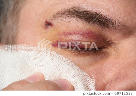 close view of a bruise near the eye, the face of a man with a hematoma close view of a bruise near the eye, the face of a man with a hematoma 69711552