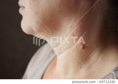 Close-up of a mole on a woman's neck Close-up of a mole on a woman's neck 69712280