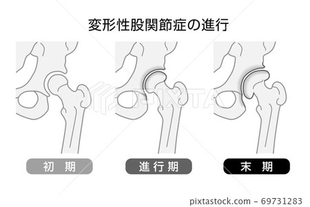 髖骨關節炎病情進展單調 69731283
