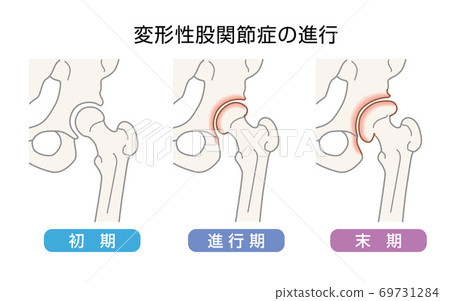 Illustration of the progression of coxarthrosis 69731284