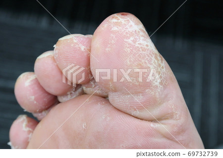 Rough skin on feet 69732739