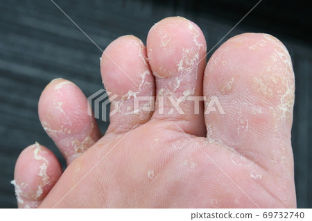 Rough skin on limbs Rough skin on limbs 69732740