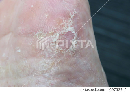 Rough skin on limbs Rough skin on limbs 69732741