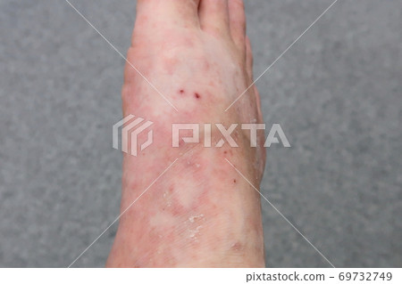 Rough skin on limbs 69732749