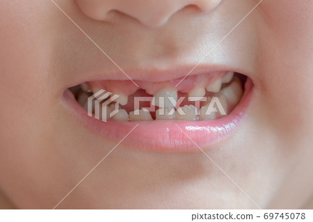 A happy little boy smile and showing his broken teeth 69745078