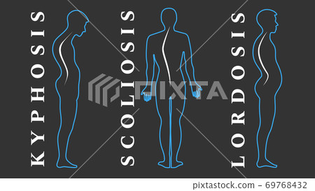 Diseases of the spine. Scoliosis, lordosis, kyphosis. Body posture defects. Back curvature. Spinal deformity types. Medical disease infographic. Diagnostic symptom. Vector illustration. 69768432