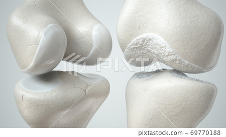 Knee osteoarthritis and healthy knee Knee osteoarthritis and healthy knee 69770188