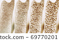 Osteoporosis course in 4 stages 69770201